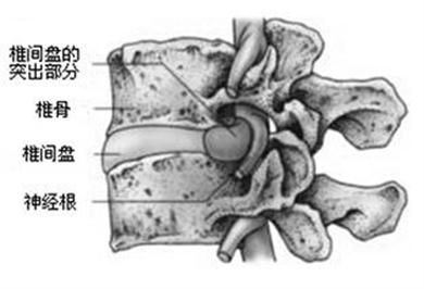 神经根型颈椎病