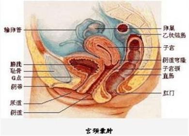 宫颈囊肿